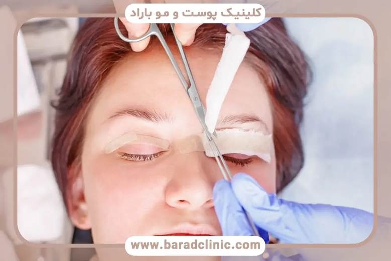 تفاوت هزینه بلفاروپلاستی پلک بالا و پایین