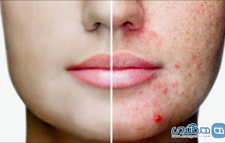 علت جوش زدن صورت نوجوانان چیست؟ + راه حل