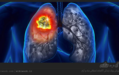 بهترین آنتی بیوتیک برای درمان عفونت ریه