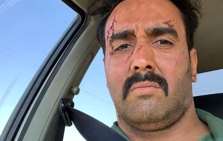 صورت زخمی پوریا پورسرخ + عکس