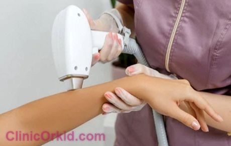 دغدغه لیزر مو بعد از سولار حل شد!

