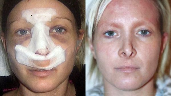 بلایی که پس از جراحی زیبایی بینی سر زن ۴۱ ساله آمد +عکس