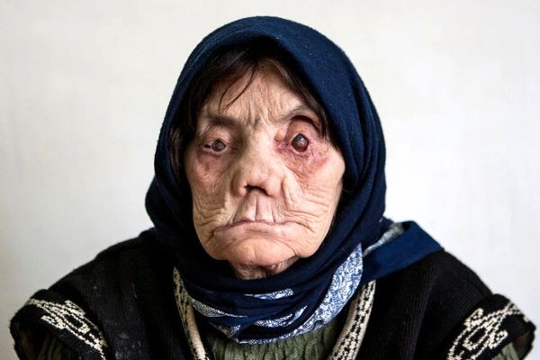 هشدار؛ شناسایی ۹ بیمار جدید مبتلا به جذام در کشور