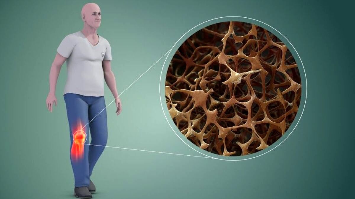 آلودگی هوا ابتلا به پوکی استخوان را افزایش می‌دهد!