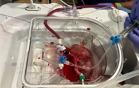 پیوند اولین کلیه هیبریدی انسان-خوک!