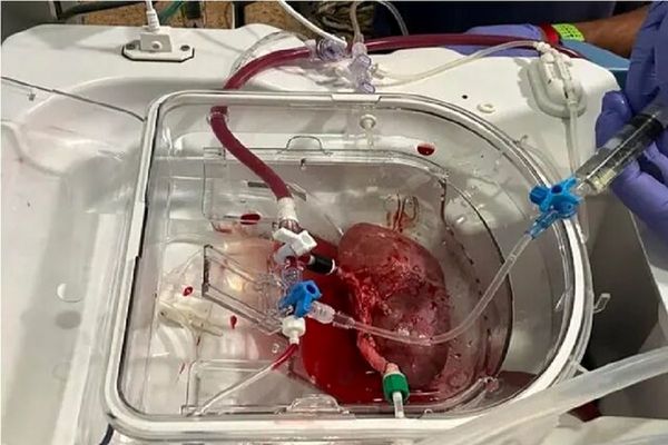 پیوند اولین کلیه هیبریدی انسان-خوک!