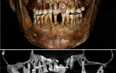 تصویر زنی که ۴۰۰ سال قبل دندان‌هایش را «سیم‌کشی» کرده بود